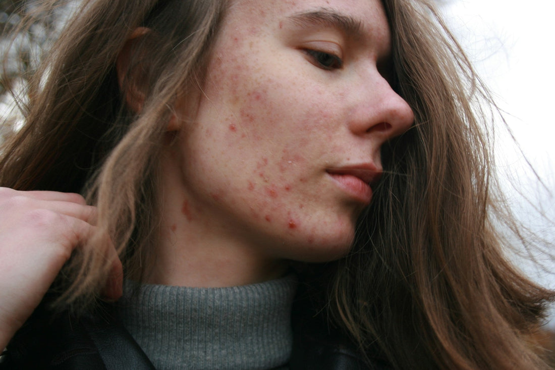 Acne & the Skin–Gut–Mind Connection: The Hidden Links That Could Transform Your Skin