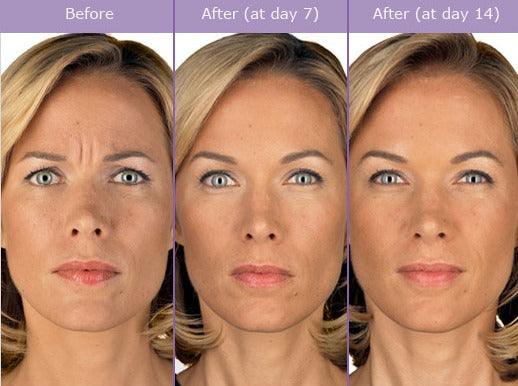 Botox 101: Everything You Need to Know Before Your First Treatment