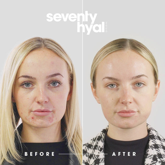 Skin Booster Seventy Hyal 2000