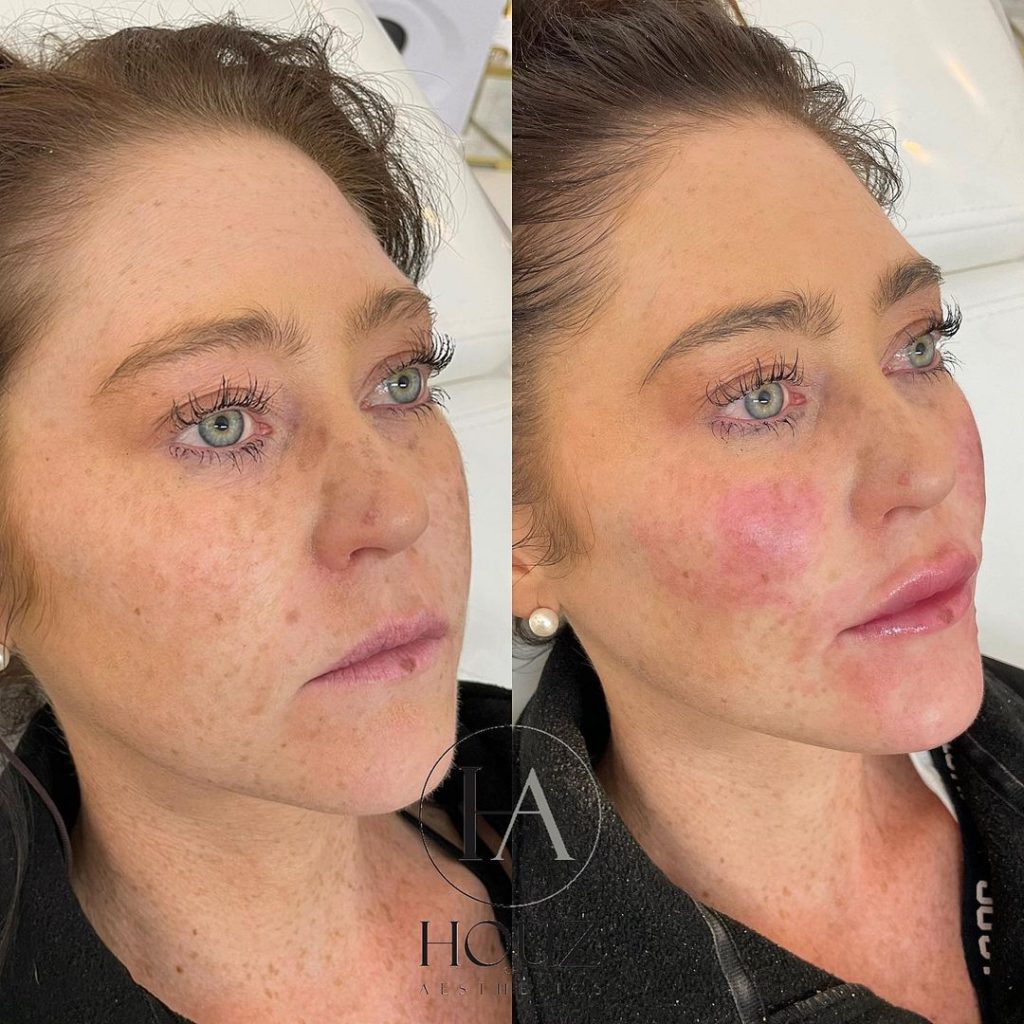 Face & Lip fillers