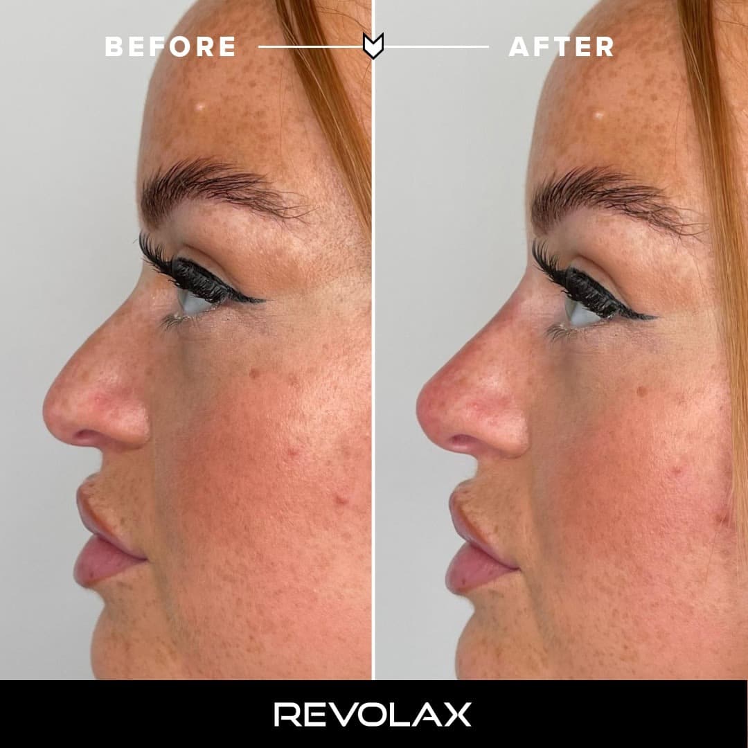 Face & Lip fillers