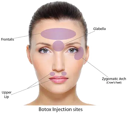 Anti-wrinkle injections (botox)