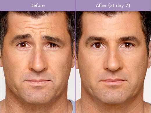 Anti-wrinkles injections