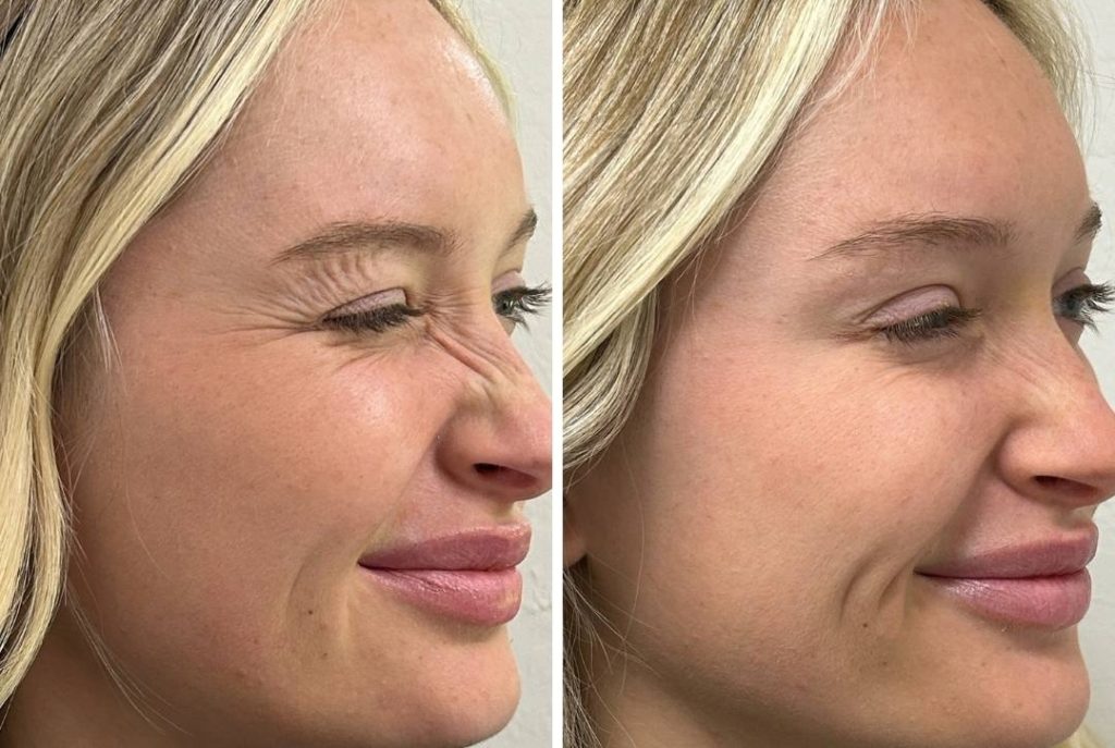 Anti-wrinkles injections