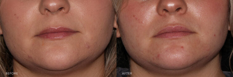 Anti-wrinkles injections