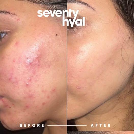 Revolutionizing Hydration: Seventy Hyal 2000 at Happy Skin by Debora Tentis