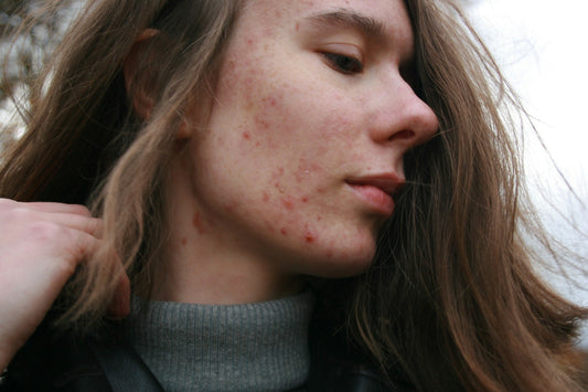 Acne & the Skin–Gut–Mind Connection: The Hidden Links That Could Transform Your Skin