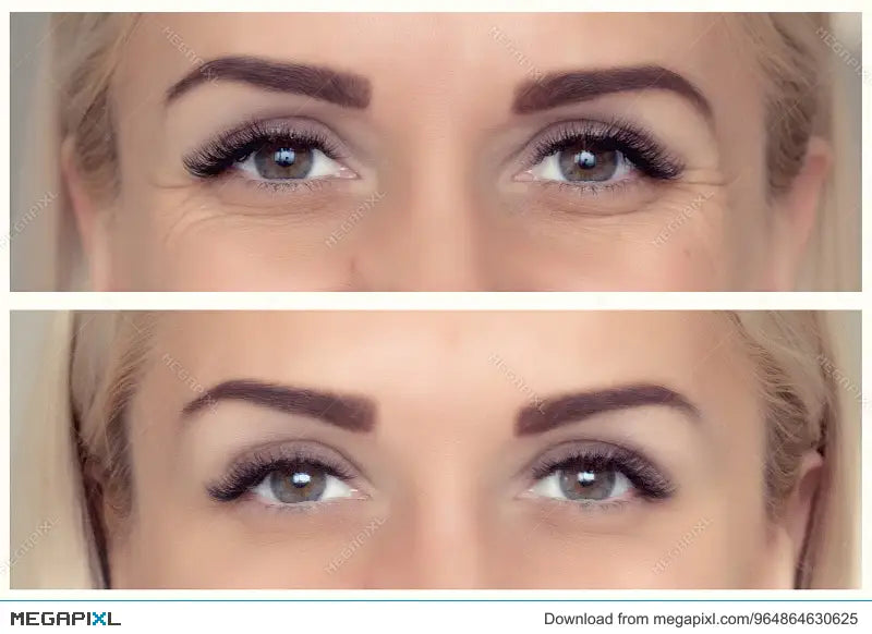 Skin Boosters & Hormone Imbalance: Aesthetic Support for Women Over 35