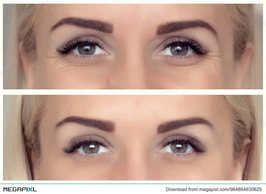 Skin Boosters & Hormone Imbalance: Aesthetic Support for Women Over 35