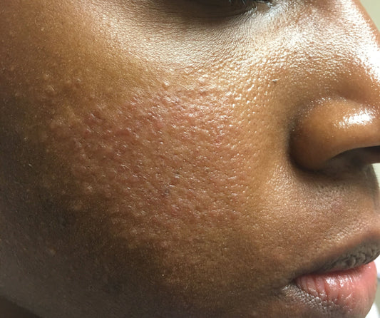 Rosacea in Skin of Colour: What It Looks Like and Why It’s Often Missed