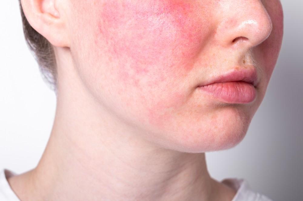 Healing Rosacea from the Gut Out: What Science Says
