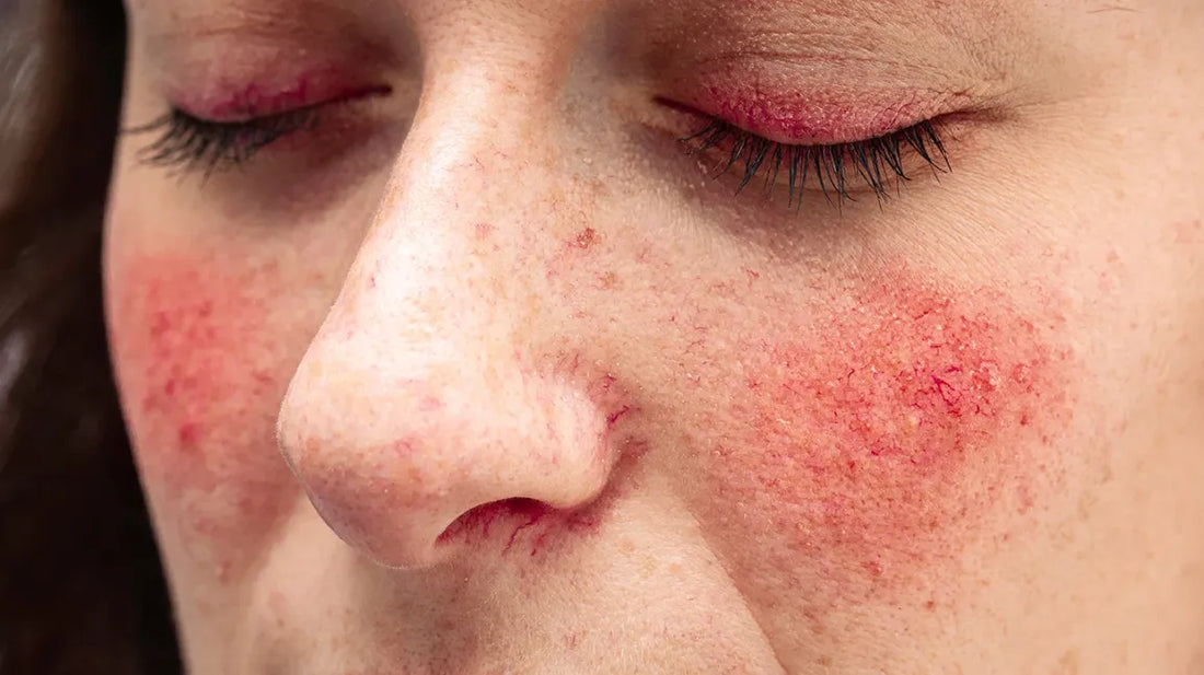 Rosacea and Food: What to Eat and Avoid for Calmer Skin