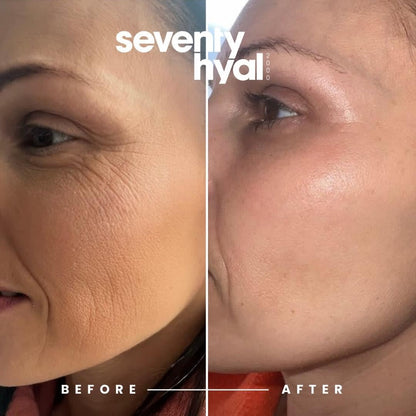 Skin boosters & polynucleotides