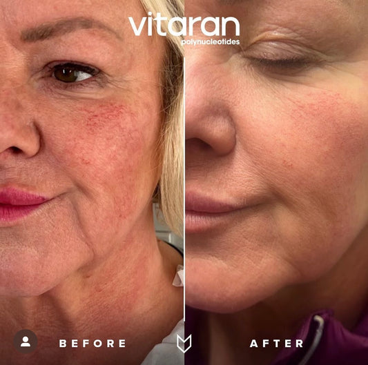 Skin boosters & polynucleotides