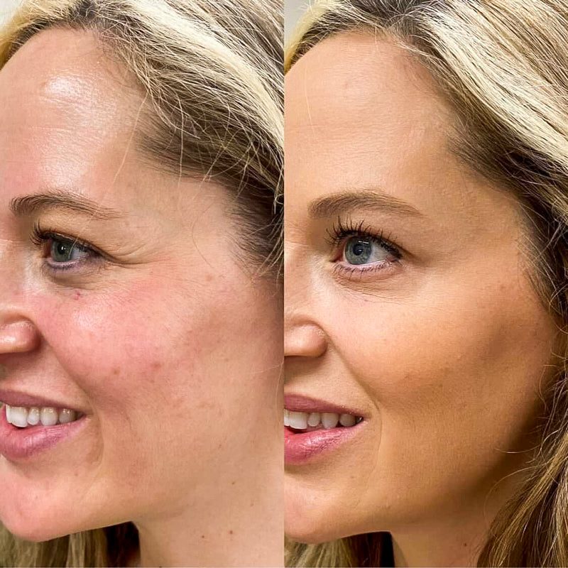 Anti-wrinkles injections