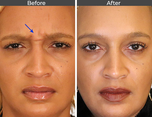 Anti-wrinkles injections