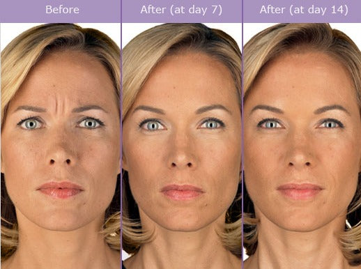Anti-wrinkles injections