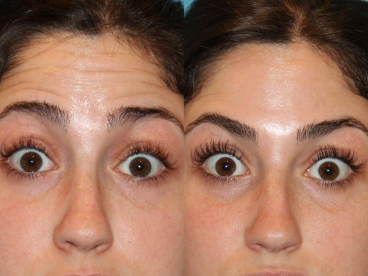 Anti-wrinkles injections