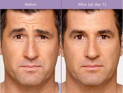 Anti-wrinkles injections